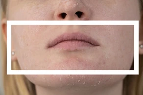 Vampire Facelift: O tratamento feito com o seu próprio sangue