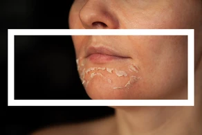 Peeling: Quando devo fazer?