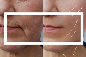 Fios de PDO: Saiba como rejuvenescer o rosto sem cirurgia!